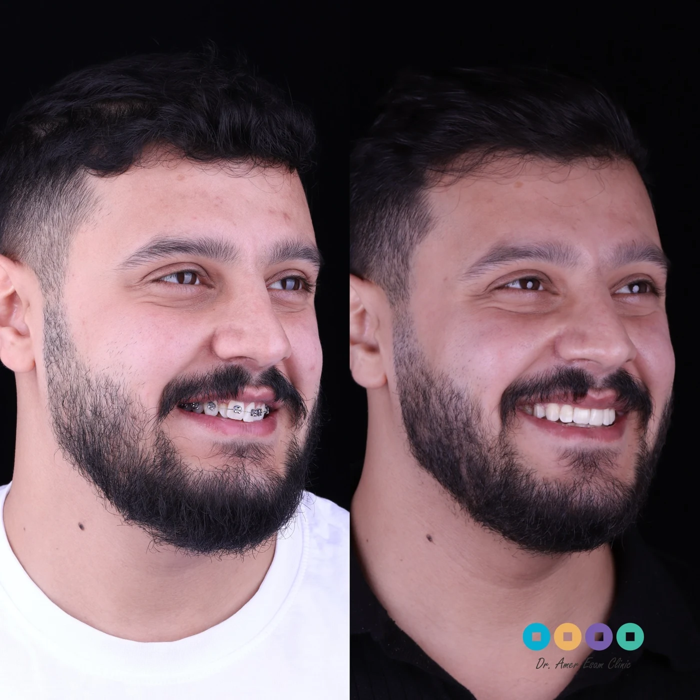نتيجة تقويم الأسنان وتعديل العضة