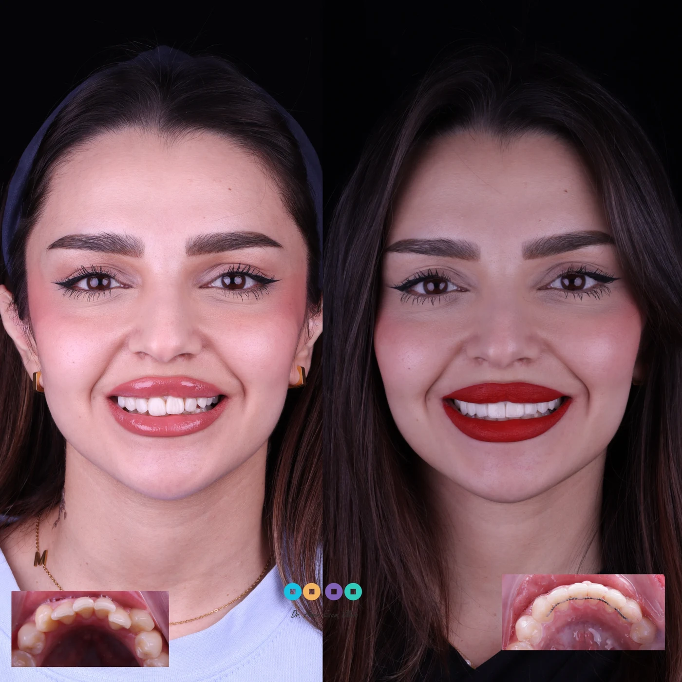 تجميل الابتسامة قبل وبعد عيادة الدكتور عامر عصام